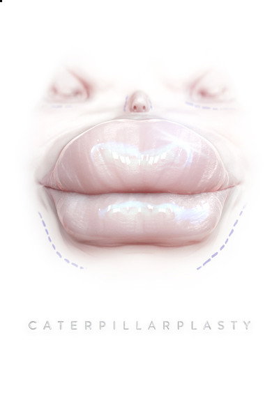Póster de Caterpillarplasty